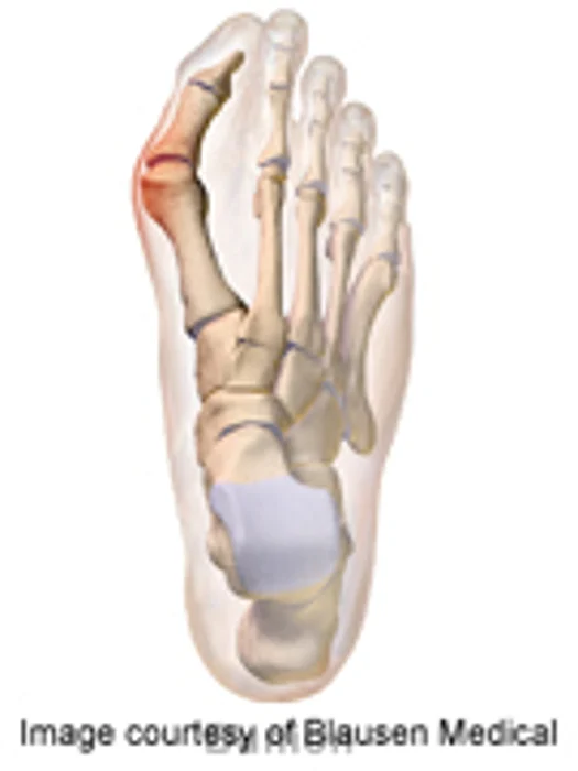Many Can Blame Family for Their Bunions