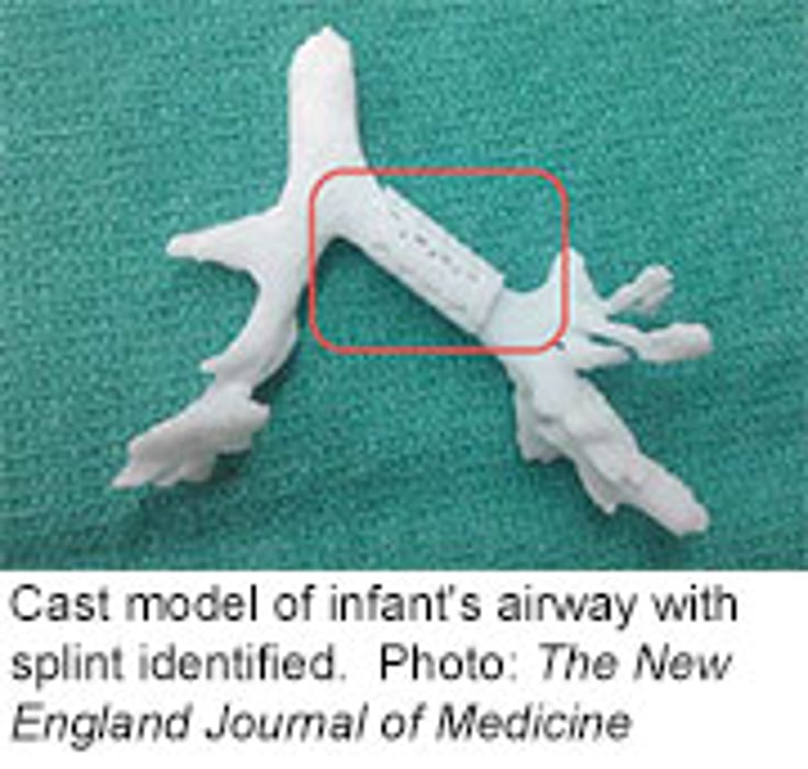 Docs Use 3-D Printer to Create Lifesaving Airway Device for Infant