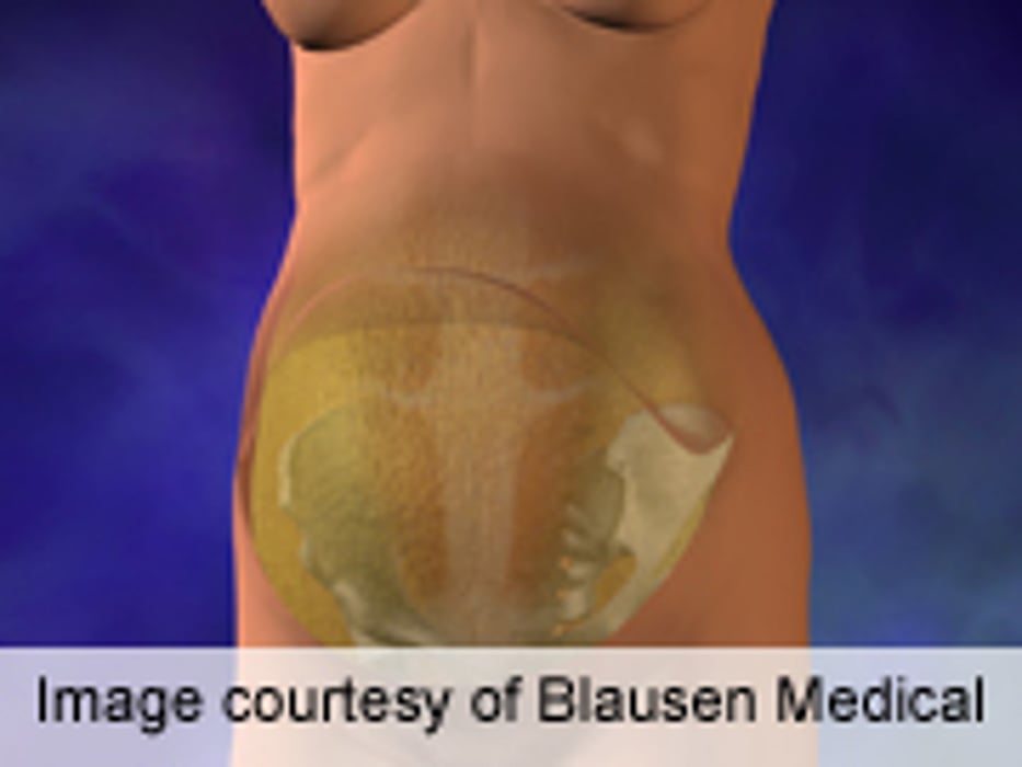Combined Liposuction, Abdominoplasty Deemed Safe