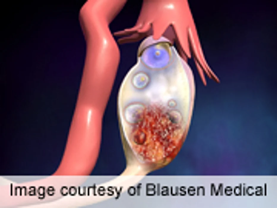 AACR: Irregular Menstrual Cycles Tied to Ovarian Cancer Risk