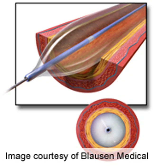 Door-to-Balloon Times Have Improved in Primary PCI
