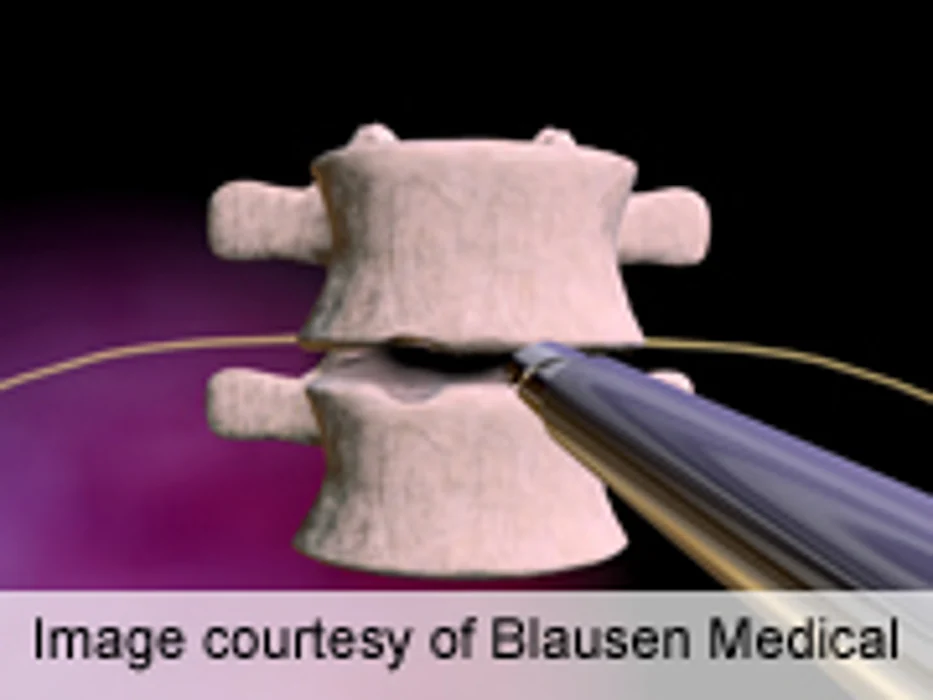 Unplanned Readmission Common After Spine Fusion