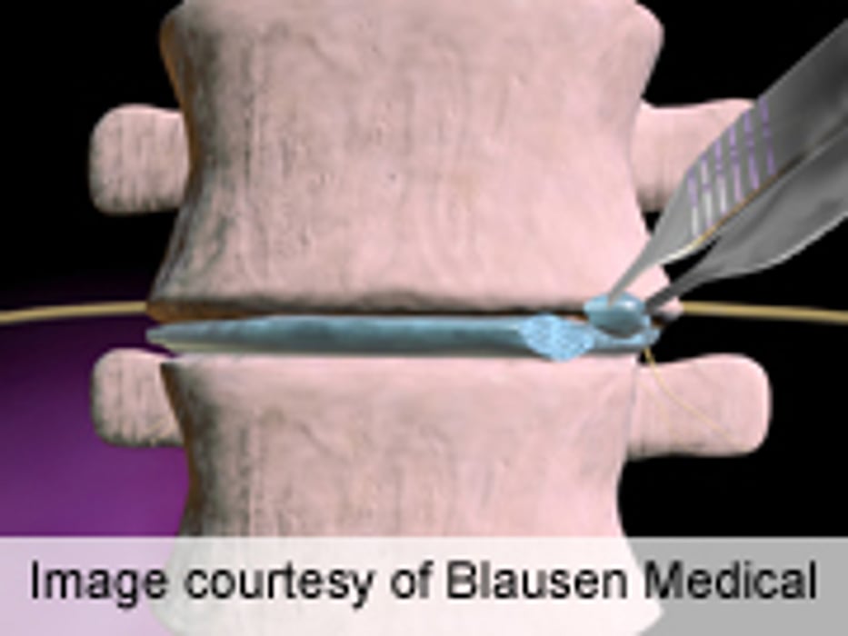 Inpatient Admissions Predict Peri-Op Risk in Lumbar Fusion