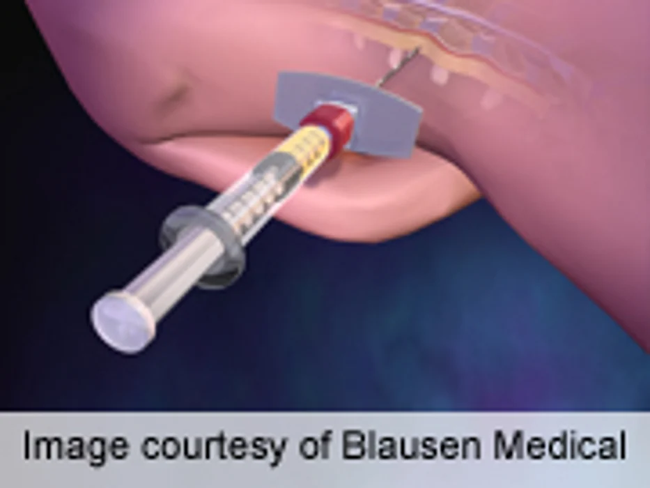 Dual Epidural Analgesia Most Effective for Scoliosis Surgery