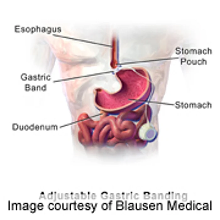 Weight-Loss Surgery Can Improve Long-Term Diabetes Control, Study Says