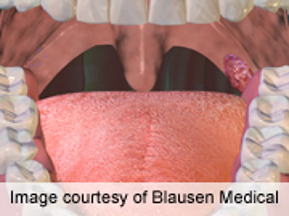 ASTRO: Oropharyngeal Cancer Cases Rising in Young Patients