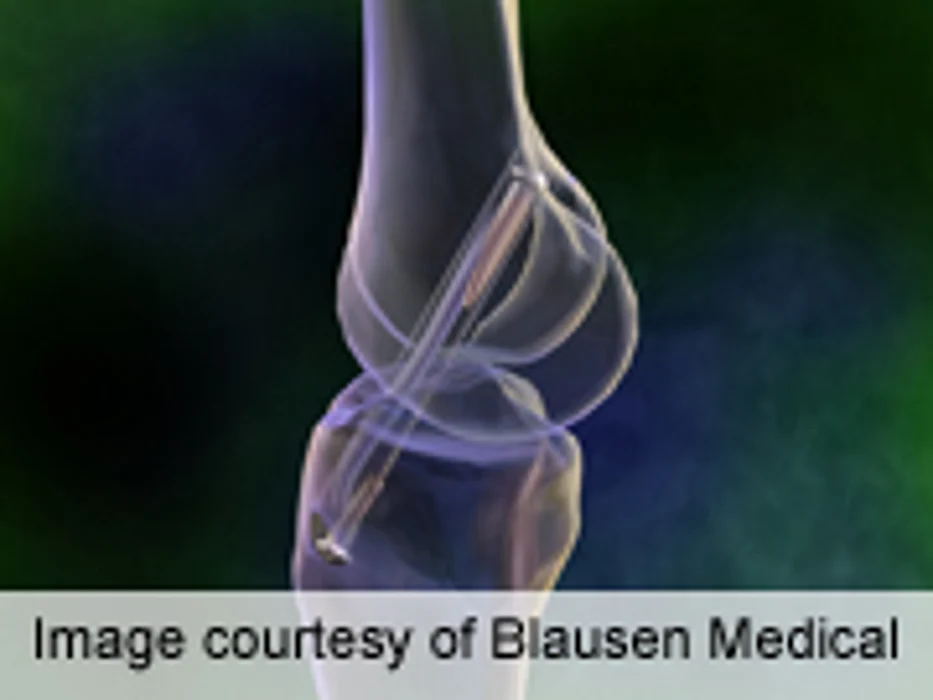 Knee Shape May Predict Who'll Benefit From ACL Surgery, Study Says