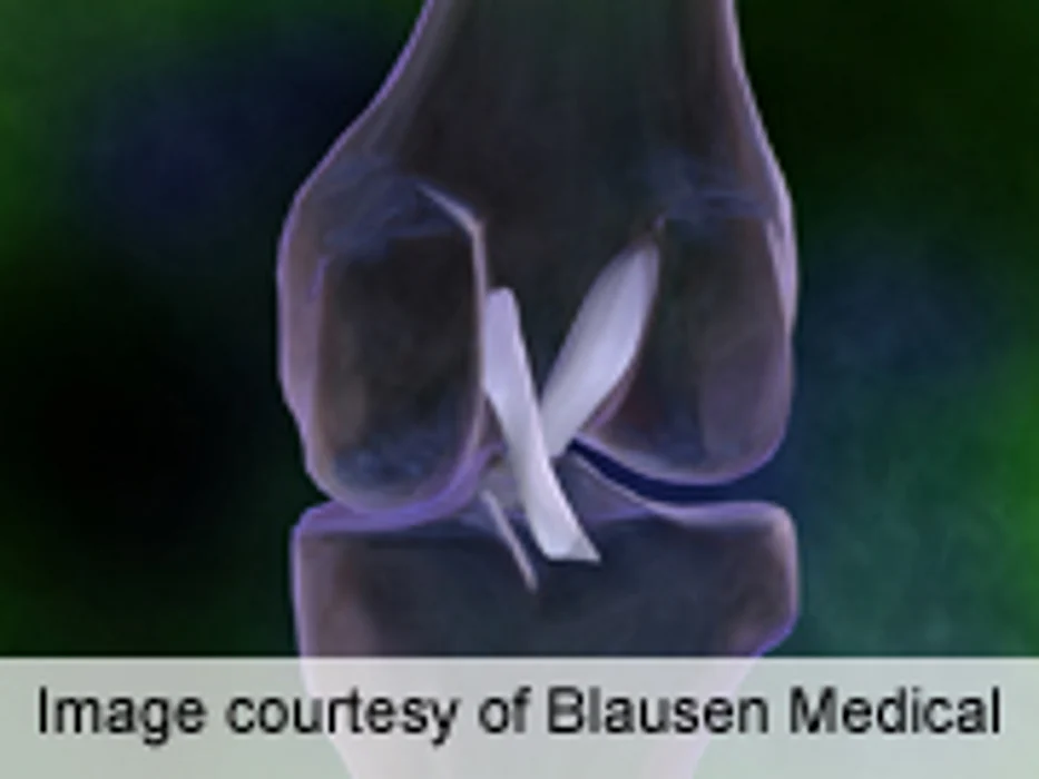After ACL Surgery, Another Knee Injury Likely, Study Suggests