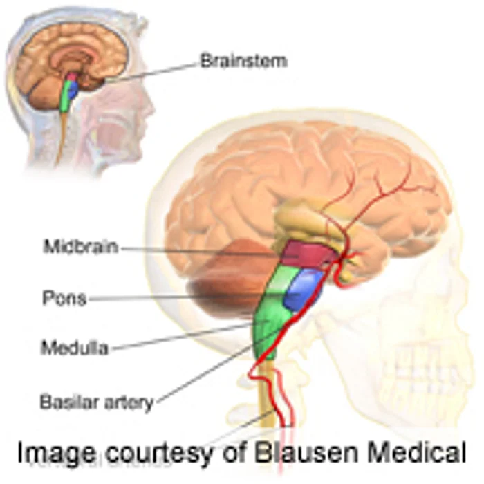 Stroke Can Cause Sleep Apnea in Some Patients