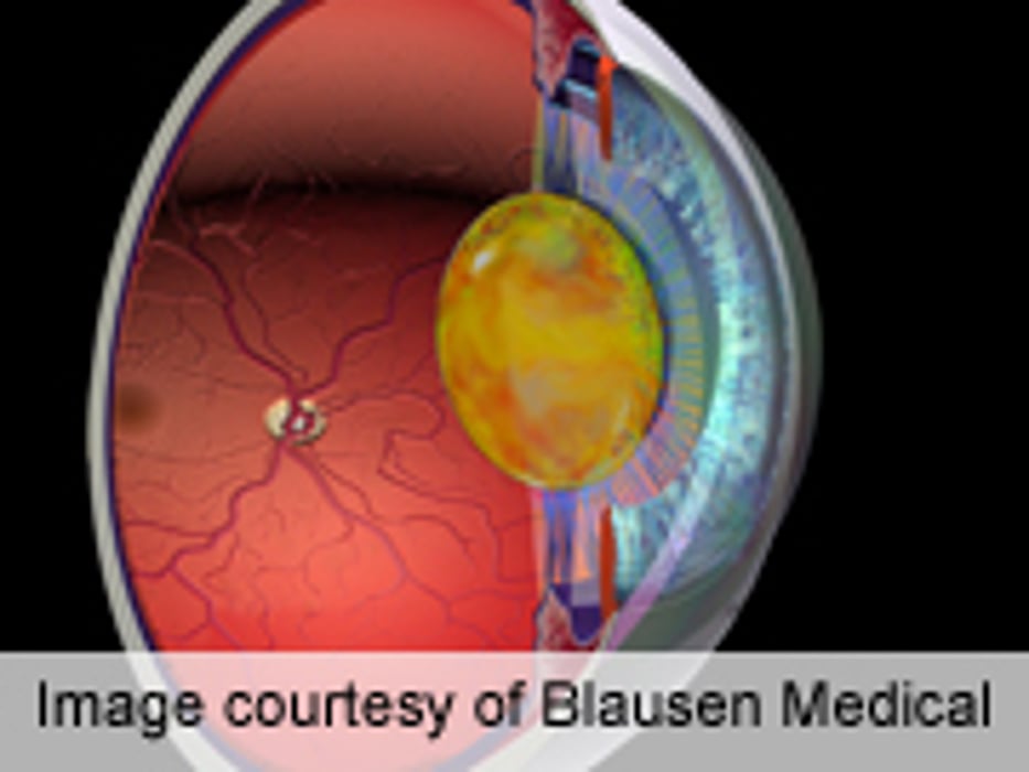 Patient-Reported Outcomes Studied for Improving Cataract Sx