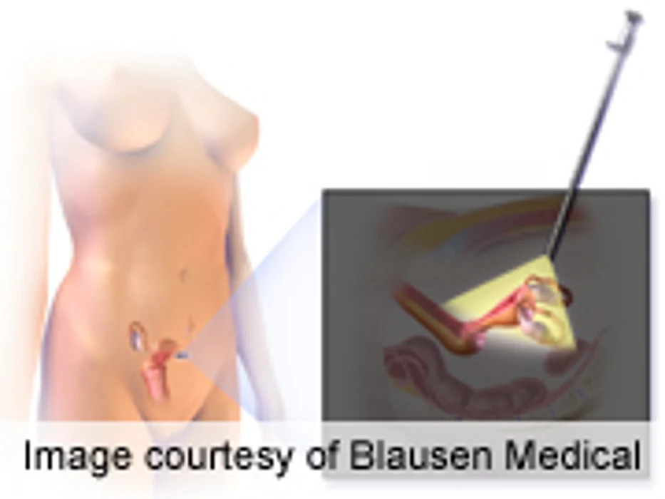 Benefits of Single-Incision Laparoscopy Unclear
