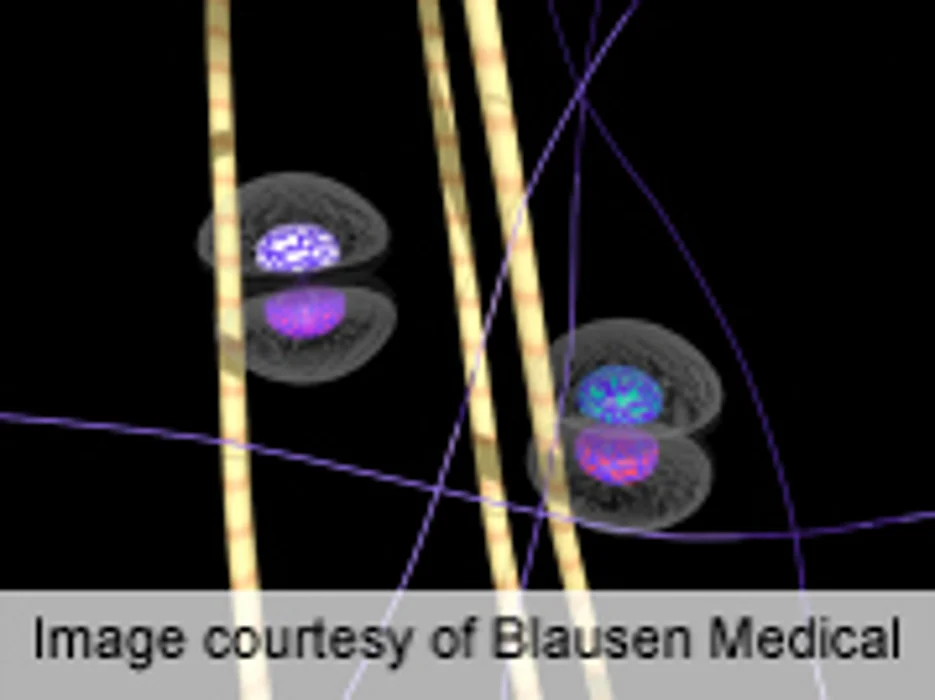 Profile of Sentinel Nodes May Predict Melanoma Progression