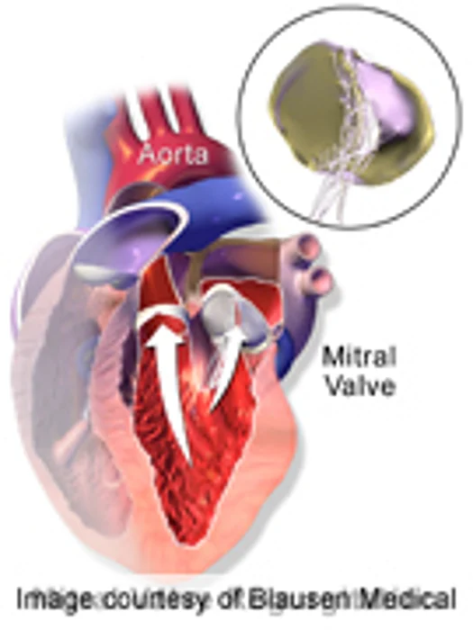 Guidance for Transcatheter Mitral Regurgitation Treatment Issued