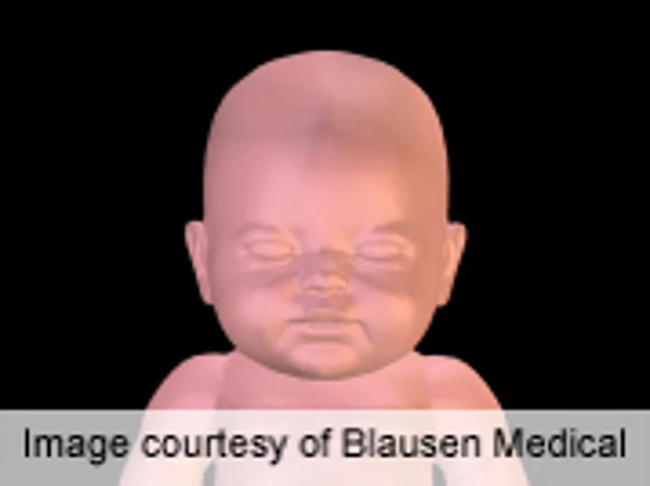 High Abusive Head Trauma Rates With New Coding Method