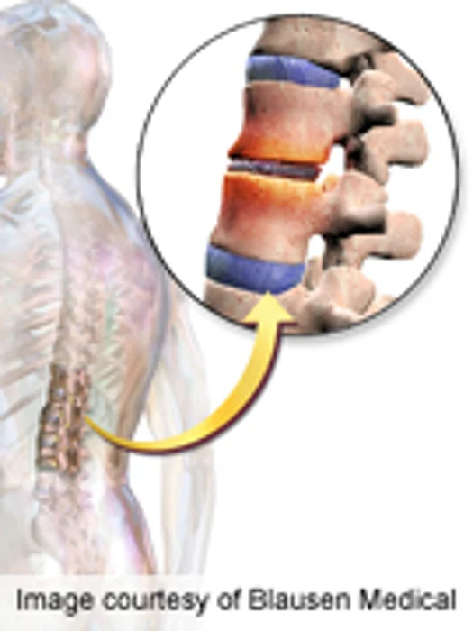 Surgery Found to Be Marginally Better for Discogenic Pain