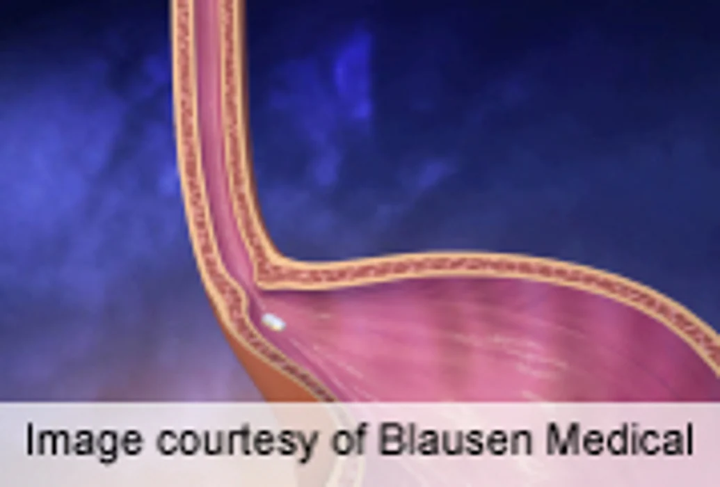 Gastric Acid Inhibitors Linked to Vitamin B12 Deficiency