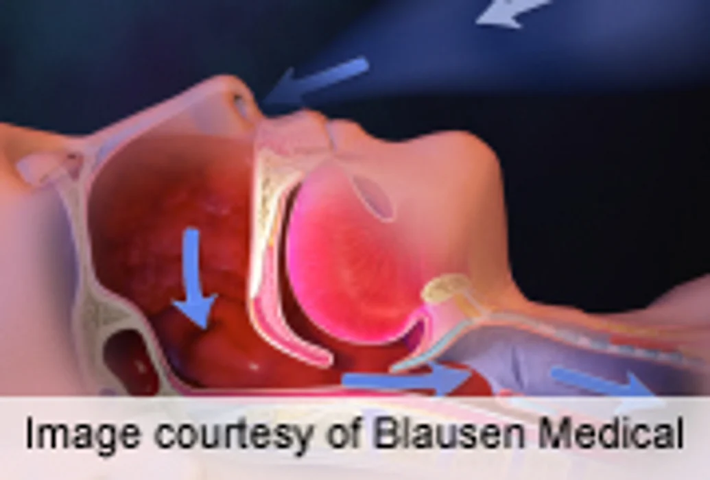 Sleep Apnea Treatment Found to Improve Resistant Hypertension