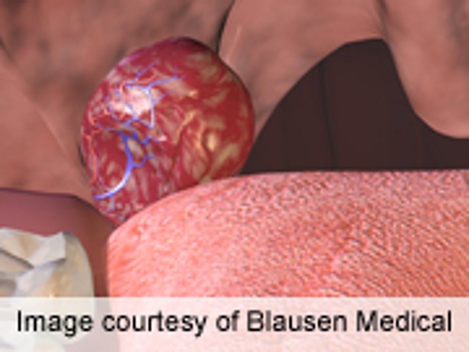 Greater Weight Gain After Early Adenotonsillectomy for OSA