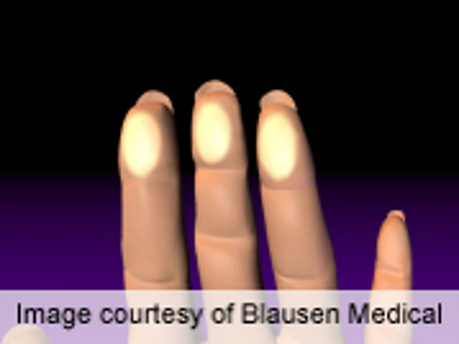 Cold Effects on Skin in Raynaud's Impacted by Age, BMI