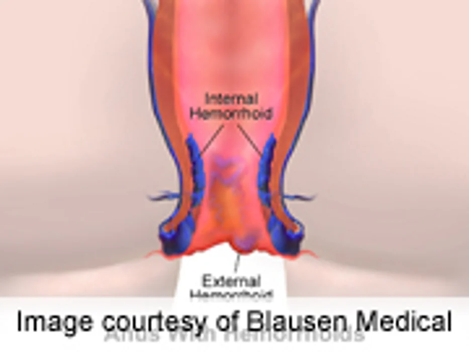 Positive Outcomes With Improved Hemorrhoidectomy Information