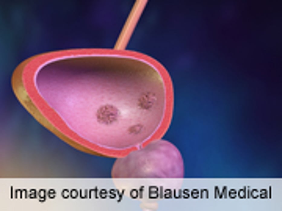 IBCG Proposes New Definition in Bladder Cancer