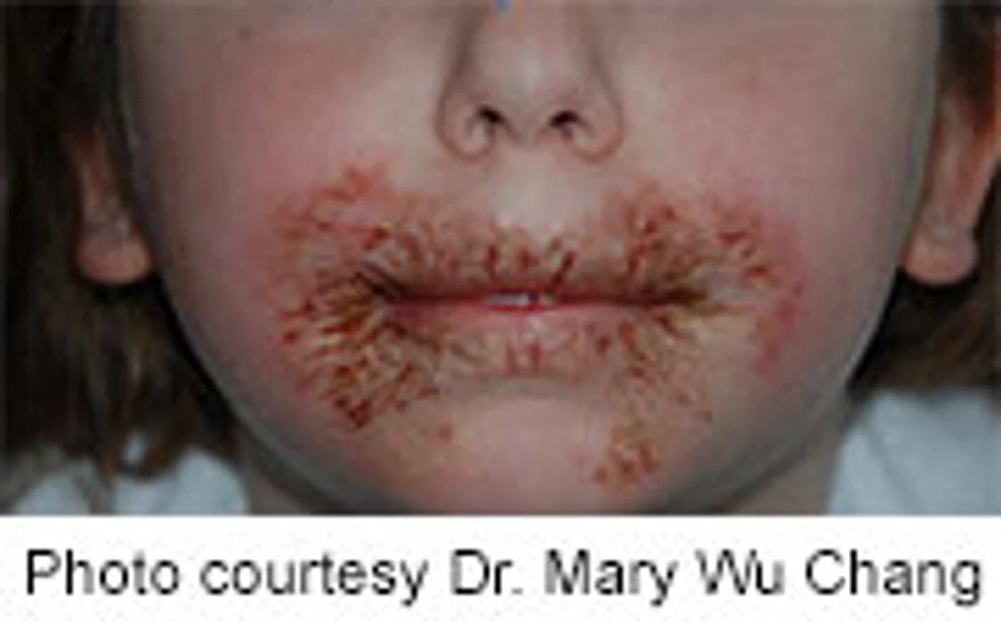 Preservative in Baby Wipes Linked to Rashes in Some Children