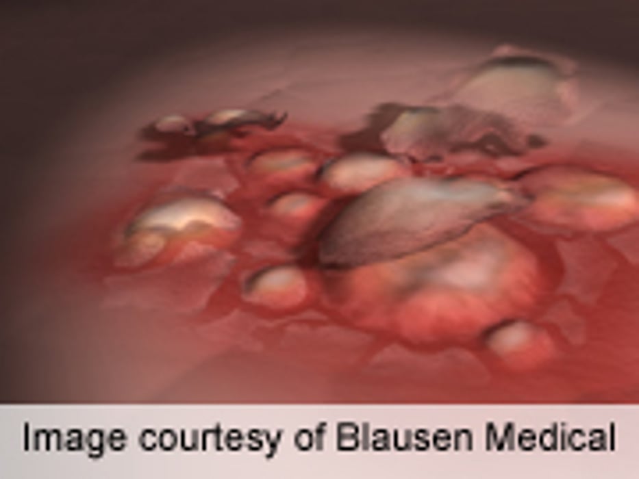 Allergic Contact Dermatitis to Methylisothiazolinone ID'd