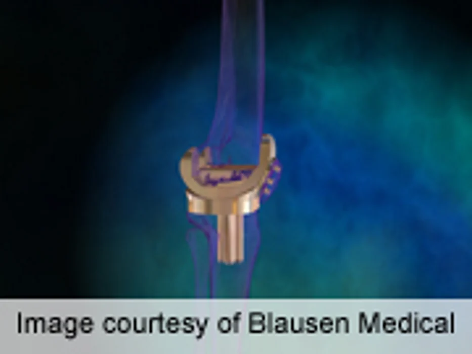 Previous Knee Surgery Ups Risk for TKA at Younger Age