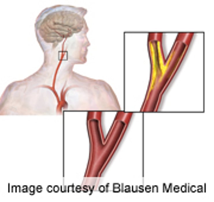 Cerebrovascular Reserve-Based Strategy Is Cost-Effective