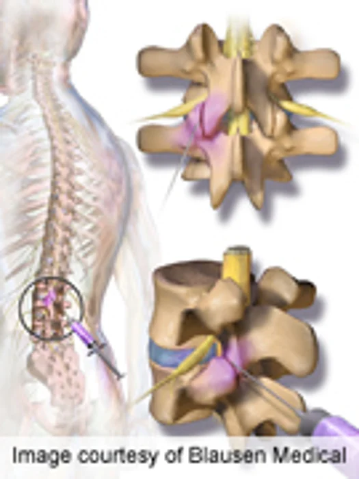 Intra-Articular, Systemic Steroids Beneficial in Back Pain