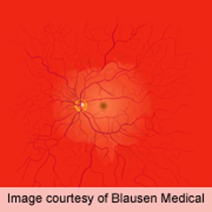 AHA: Retinal Damage Linked to Atrial Fibrillation