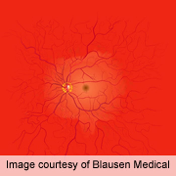 AHA: Retinal Damage Linked to Atrial Fibrillation