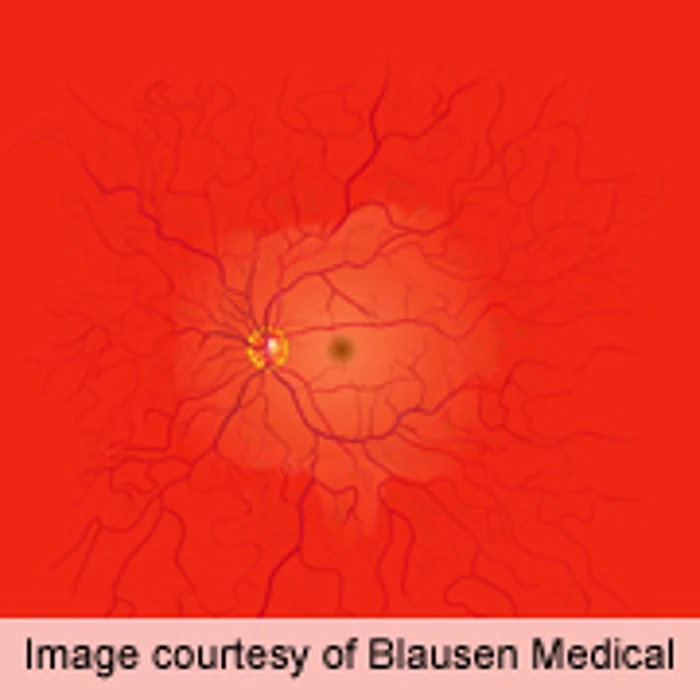 AHA: Retinal Damage Linked to Atrial Fibrillation