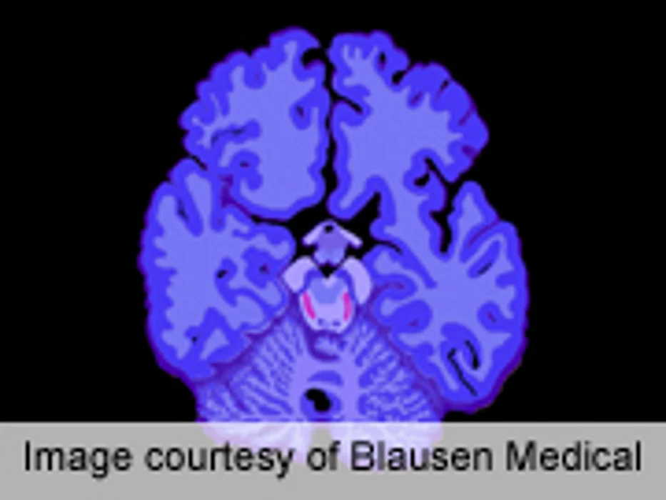 Marker in Spinal Fluid Predicts Course in Parkinson's Disease