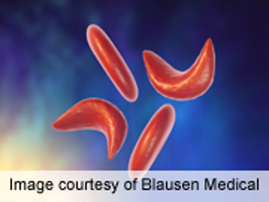 ASN: Sickle Cell Trait Linked to Risk of Chronic Kidney Disease
