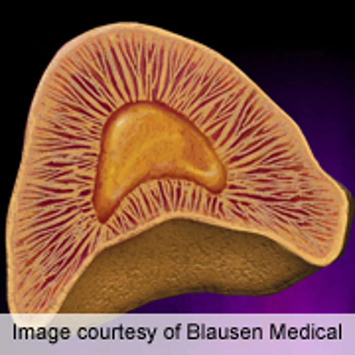Study IDs Cardiovascular Risk for 'Silent' Adrenal Tumors