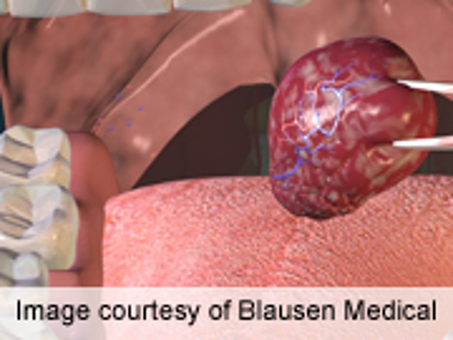 Low Morbidity/Mortality Rates for Adult Tonsillectomy in U.S.