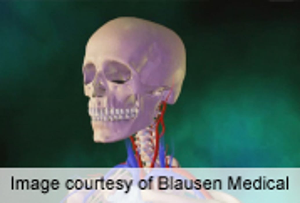 ASA: Head or Neck Injury Ups Stroke Risk After Trauma