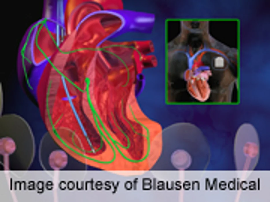 Routine Oral Anticoagulants May Not Benefit All With A-Fib