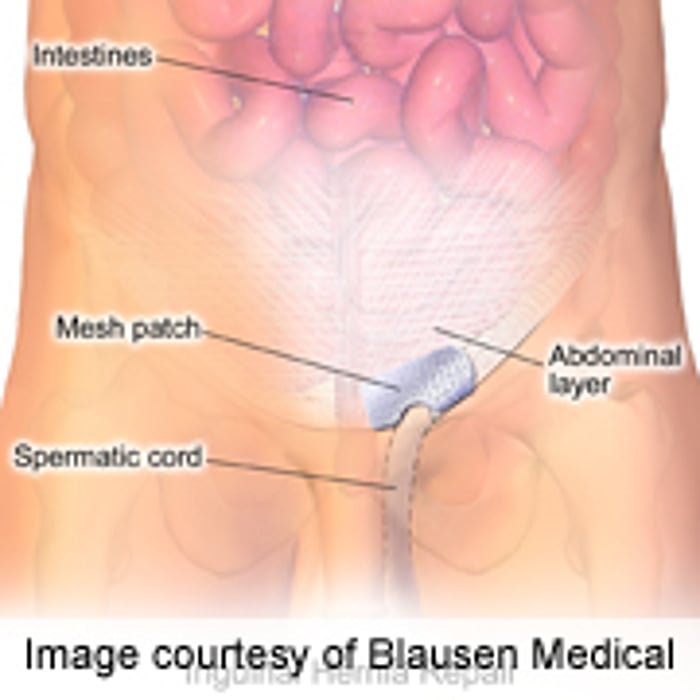 Mesh Ventral Hernia Repair Has Lower Recurrence Rate