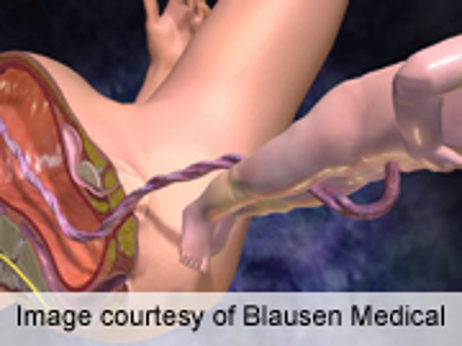 Cord Clamping Timing Affects Neonatal Outcome