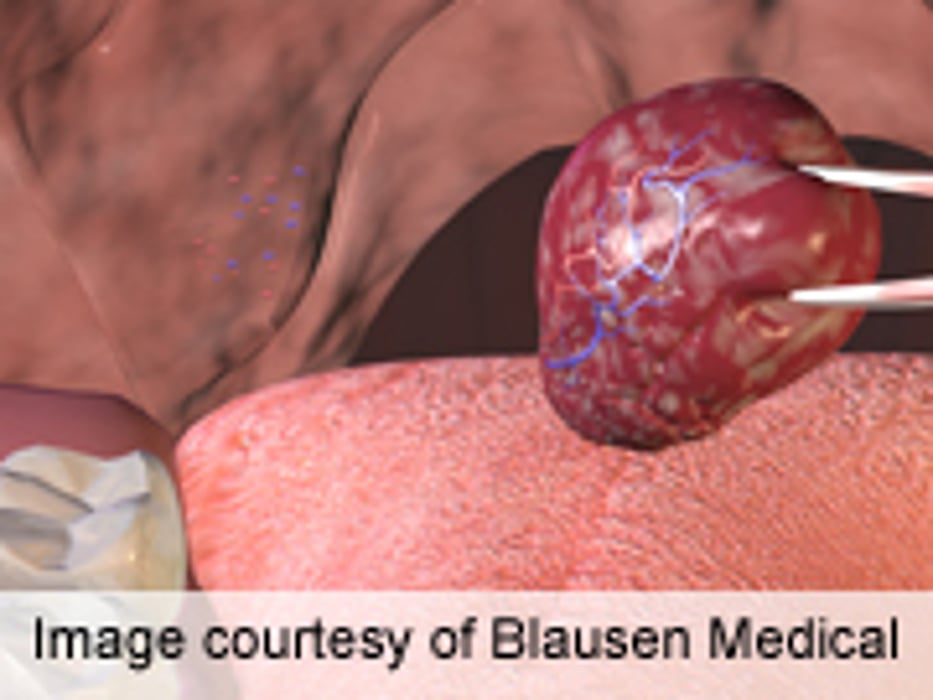 Some Children Gain Weight After Tonsil Removal Surgery