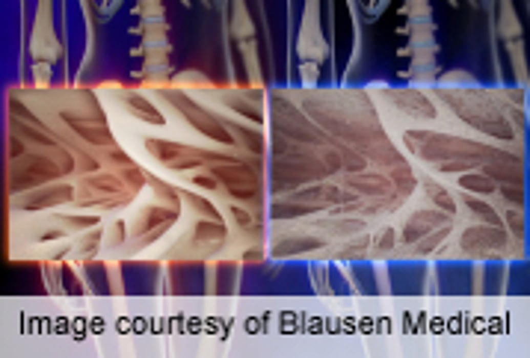 Obstructive Sleep Apnea Linked to Osteoporosis