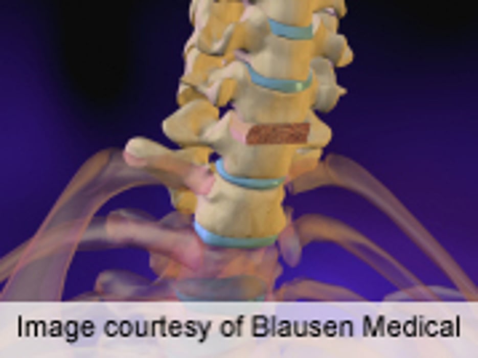 Wrong-Level Localization in Spine Surgey Rare but Still Occurs