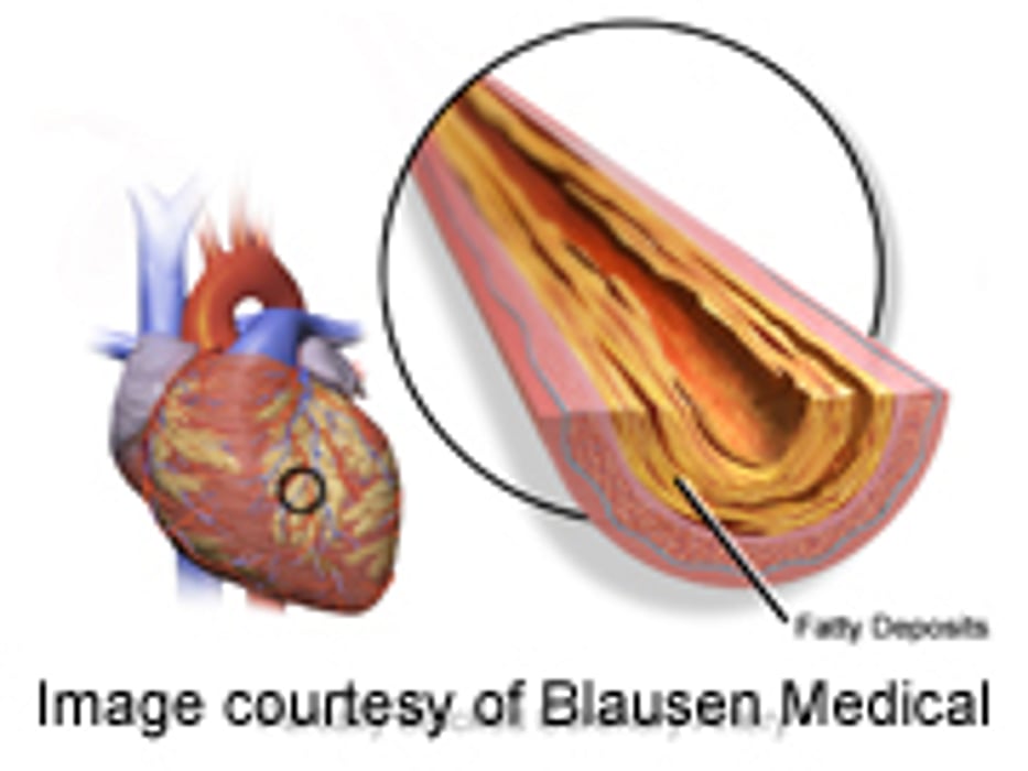 Even Early Signs of Plaque in Arteries Signal Heart Risk