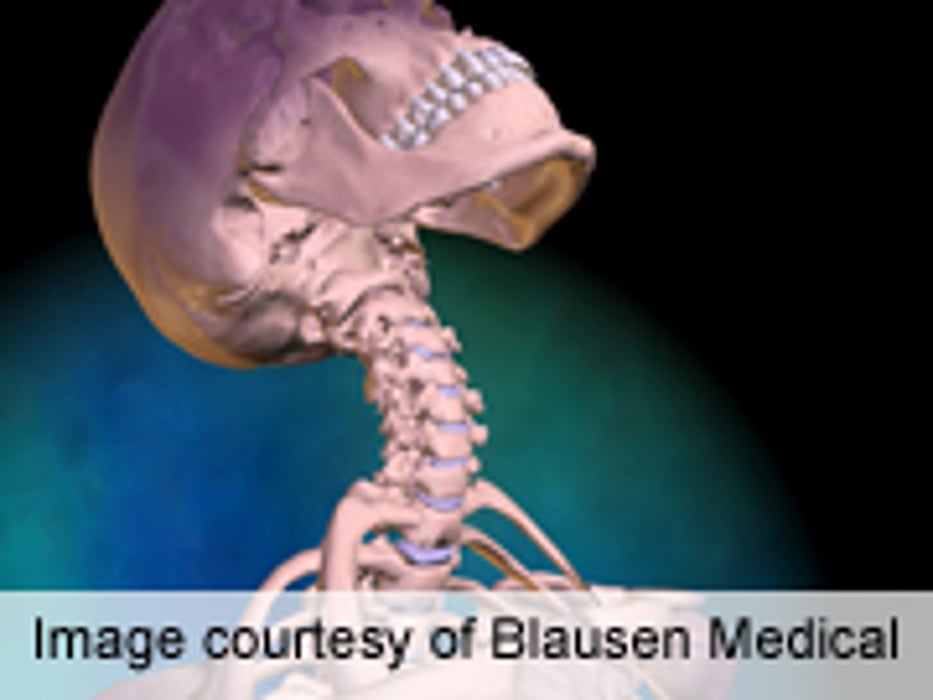 Advice, Exercise Equally Effective for Chronic Whiplash