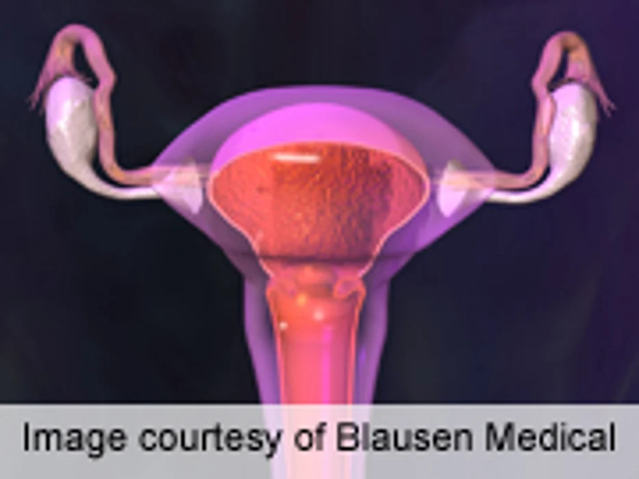 Spotting May Be Endometriosis Marker for Women With Infertility
