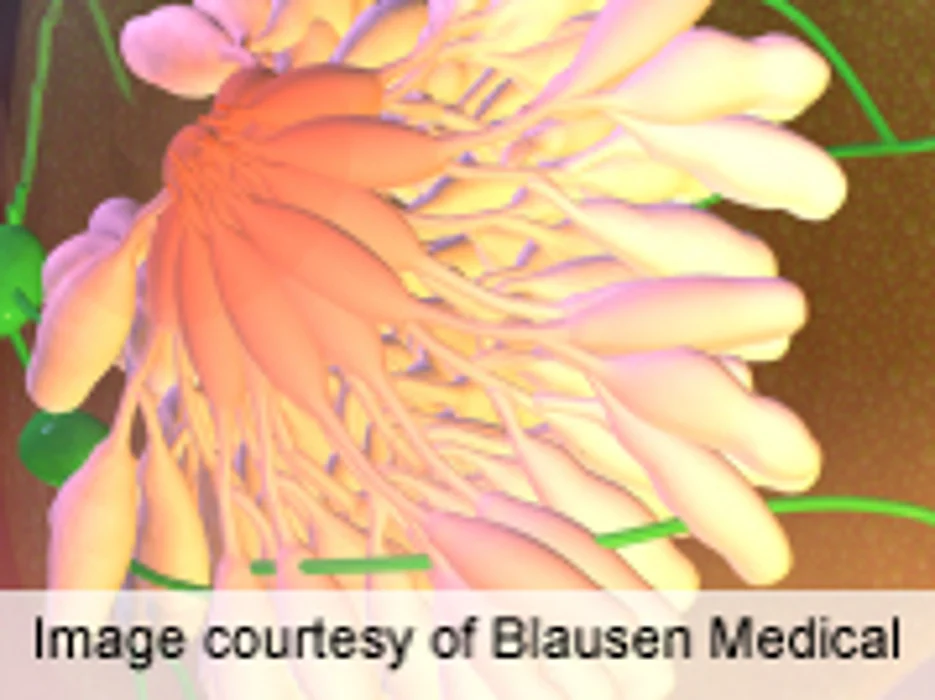 Risk of Leukemia Tied to Breast Cancer Rx Higher Than Thought