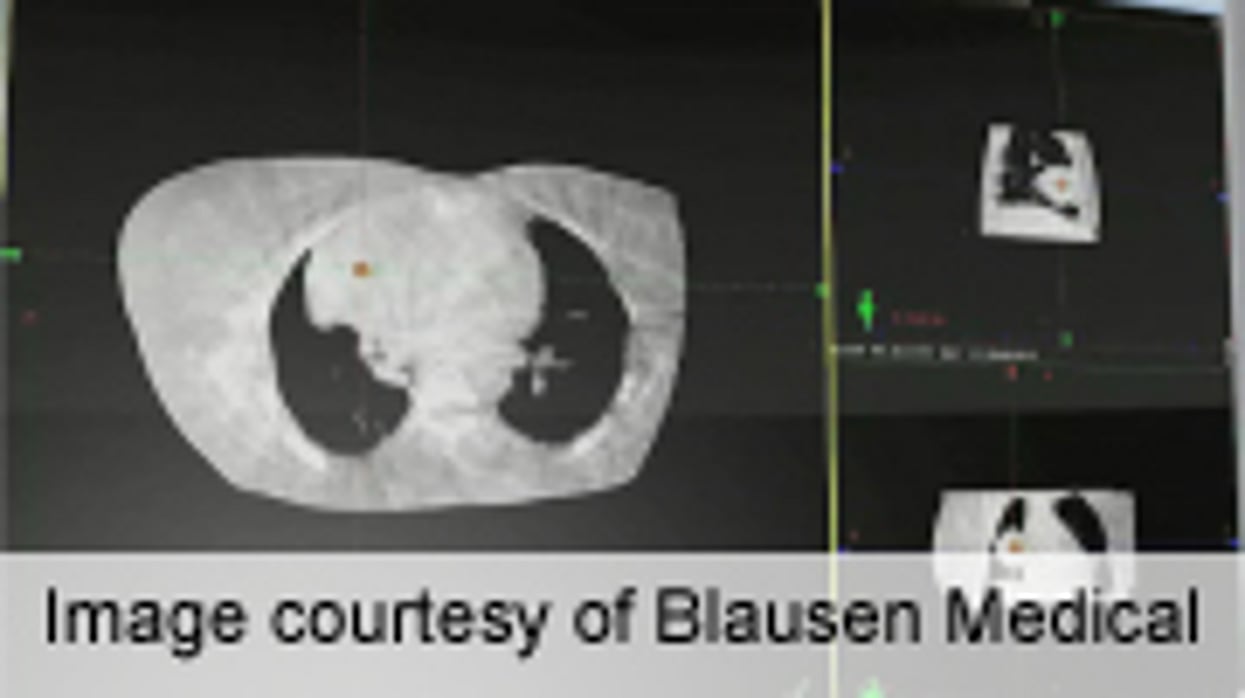 Strategies Presented to Avoid Overzealous Lung CA Screening