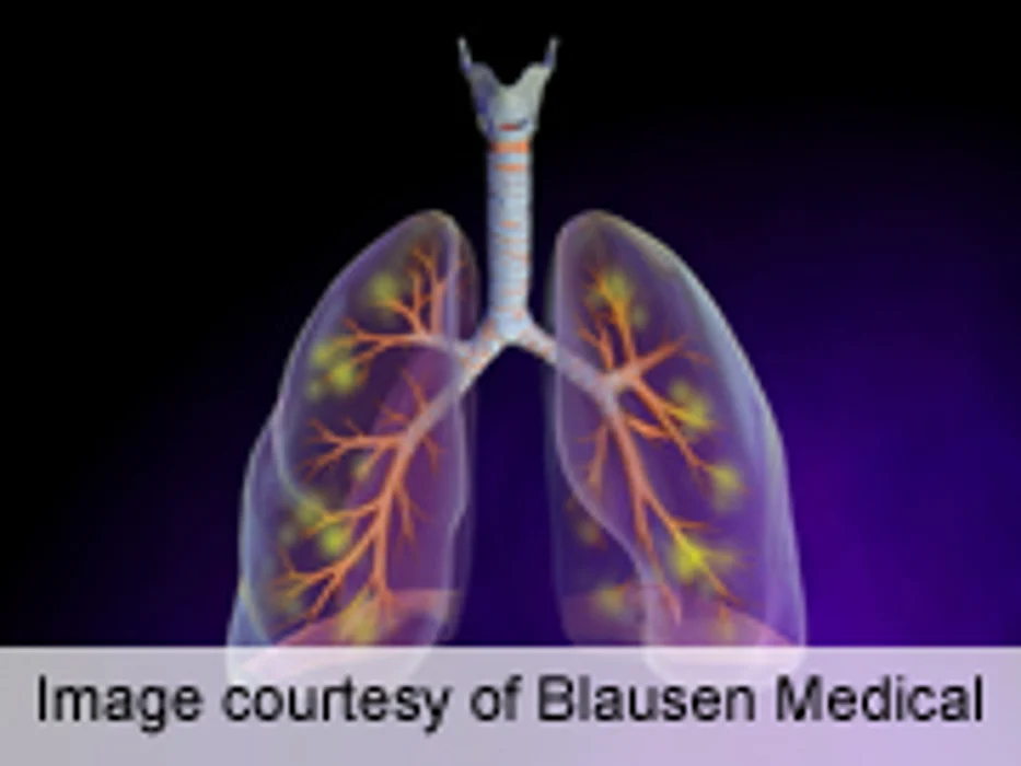 ESPID: Ultrasound, X-Ray Similar for ID'ing Pediatric Pneumonia